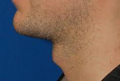 Tracheal Shave | Seattle Facial Plastic Surgeon| Dr. Lamperti | Seattle, WA
